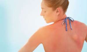 რა უნდა ვიცოდეთ მზით დამწვრობის თავიდან ასაცილებლად &ndash; დაავადებათა კონტროლის ეროვნული ცენტრის რეკომენდაციები